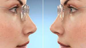 High Index Lenses